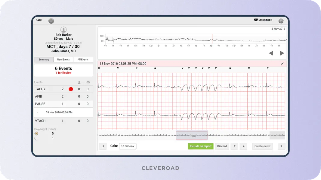 ELectrocardiogram (ECG) example