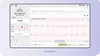 ELectrocardiogram (ECG) example
