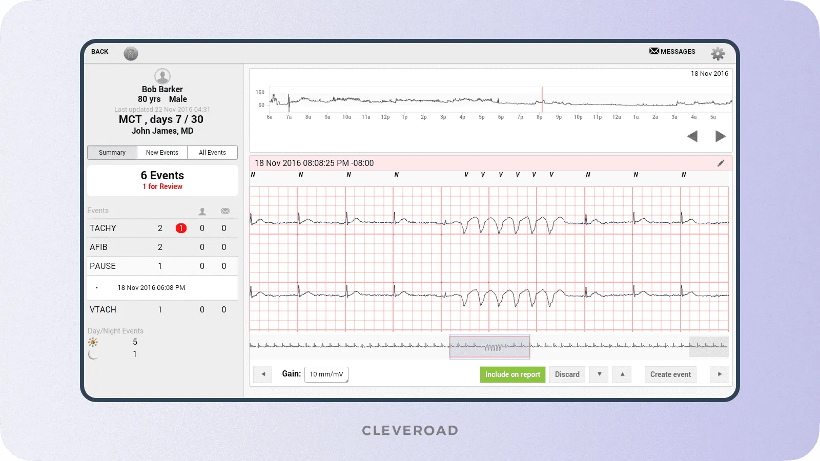 ELectrocardiogram (ECG) example